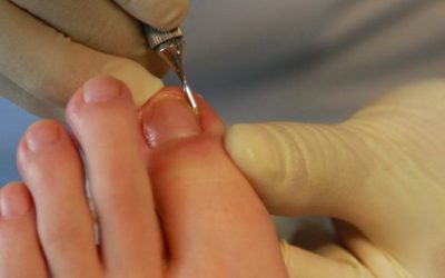 ¿Qué es la quiropodia y para qué sirve?