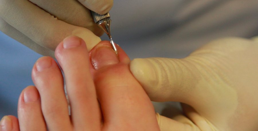 ¿Qué es la quiropodia y para qué sirve?