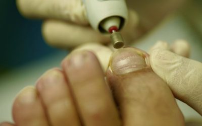 Quiropodia: ¿Cuándo es necesario realizarla?