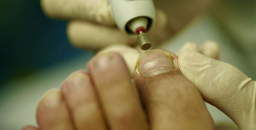 Quiropodia: ¿Cuándo es necesario realizarla?