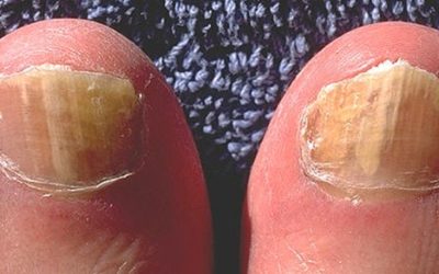 Uñas con hongos: Tratamiento efectivo con un profesional en podología.