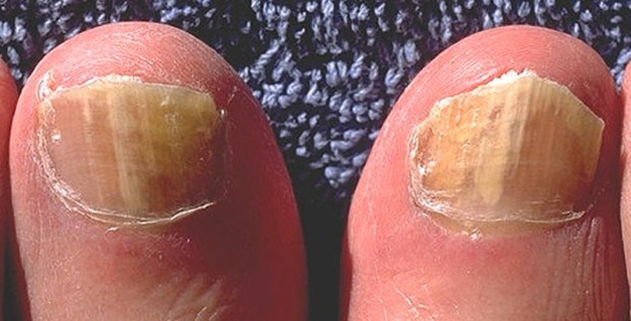 Uñas con hongos: Tratamiento efectivo con un profesional en podología.